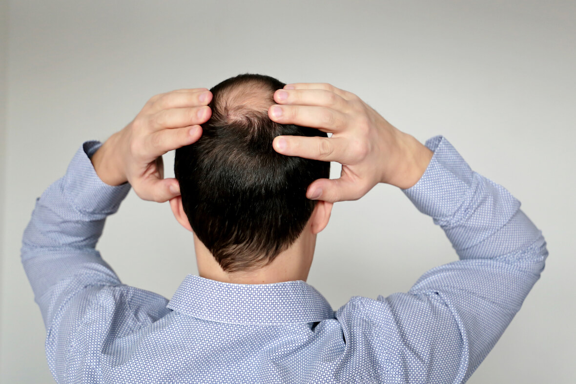 A Guide To Hair Loss Disorders Diagnosis Treatment More Angeline