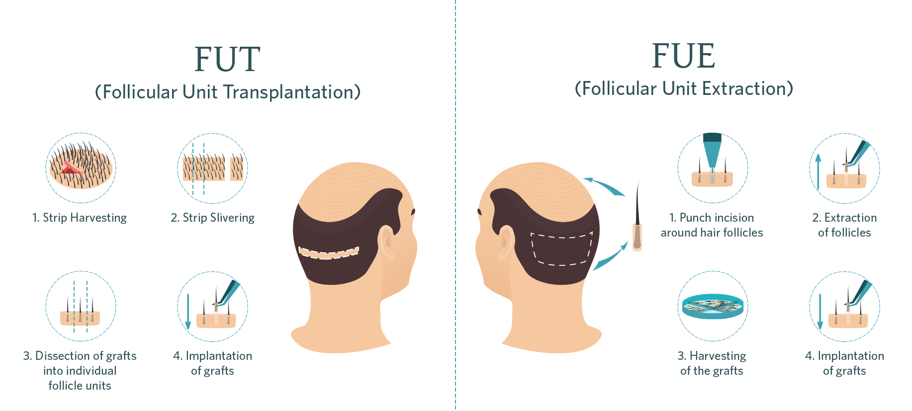 FUE & FUT Hair Transplant Surgery in Singapore | AYD Clinic