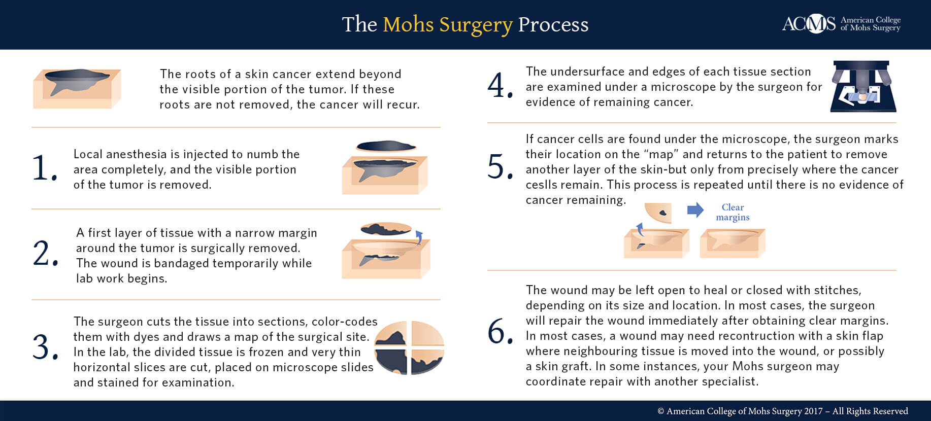 MOHS MICROGRAPHIC SURGERY 