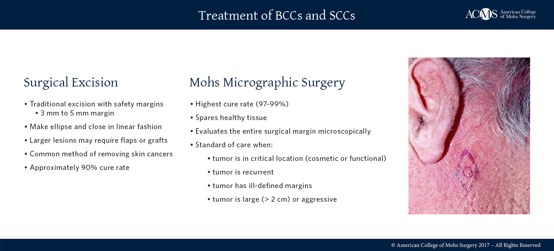 Angeline Yong Dermatology Wide Local Excisions For Skin Cancers