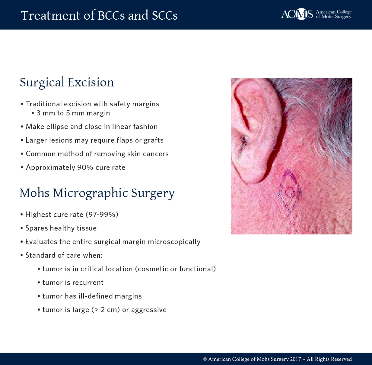 Wide Local Excision Procedure Steps Online