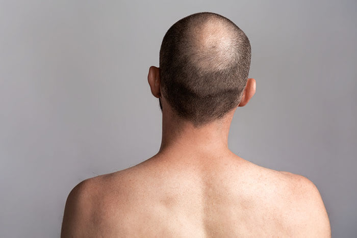 A Beginner's Guide To Hair Transplants & How It Works - Angeline Yong  Dermatology