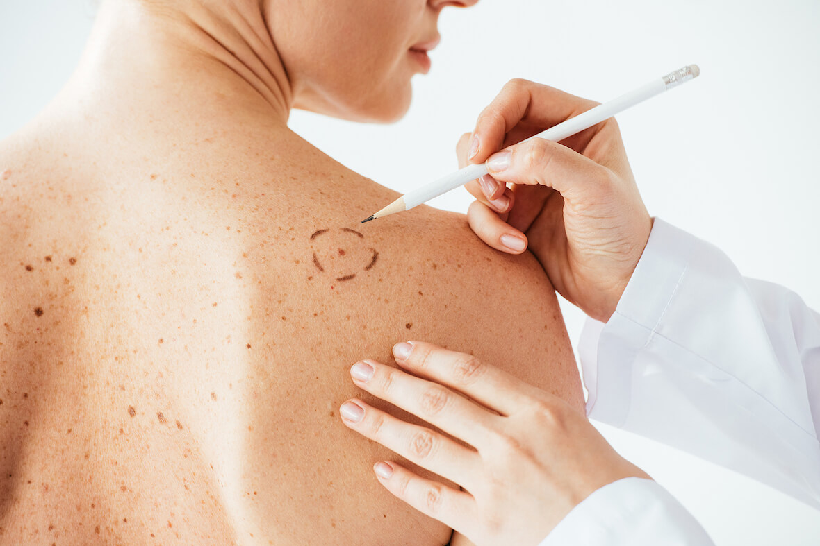 Mohs Micrographic Surgery, Skin Cancer Treatment