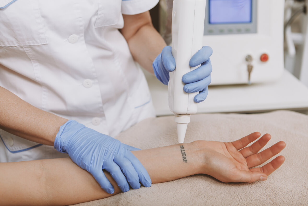 Pico Laser Technology: Tattoo Removal Has Never Been So Easy - Angeline  Yong Dermatology