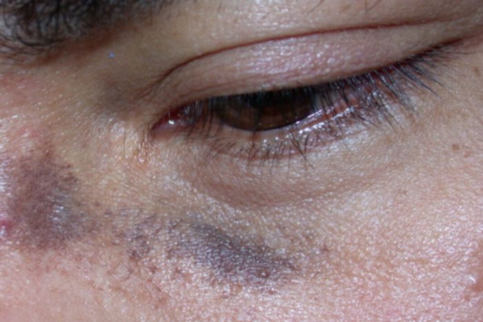 nevus-of-ota-more-than-a-simple-case-of-hyperpigmentation-angeline