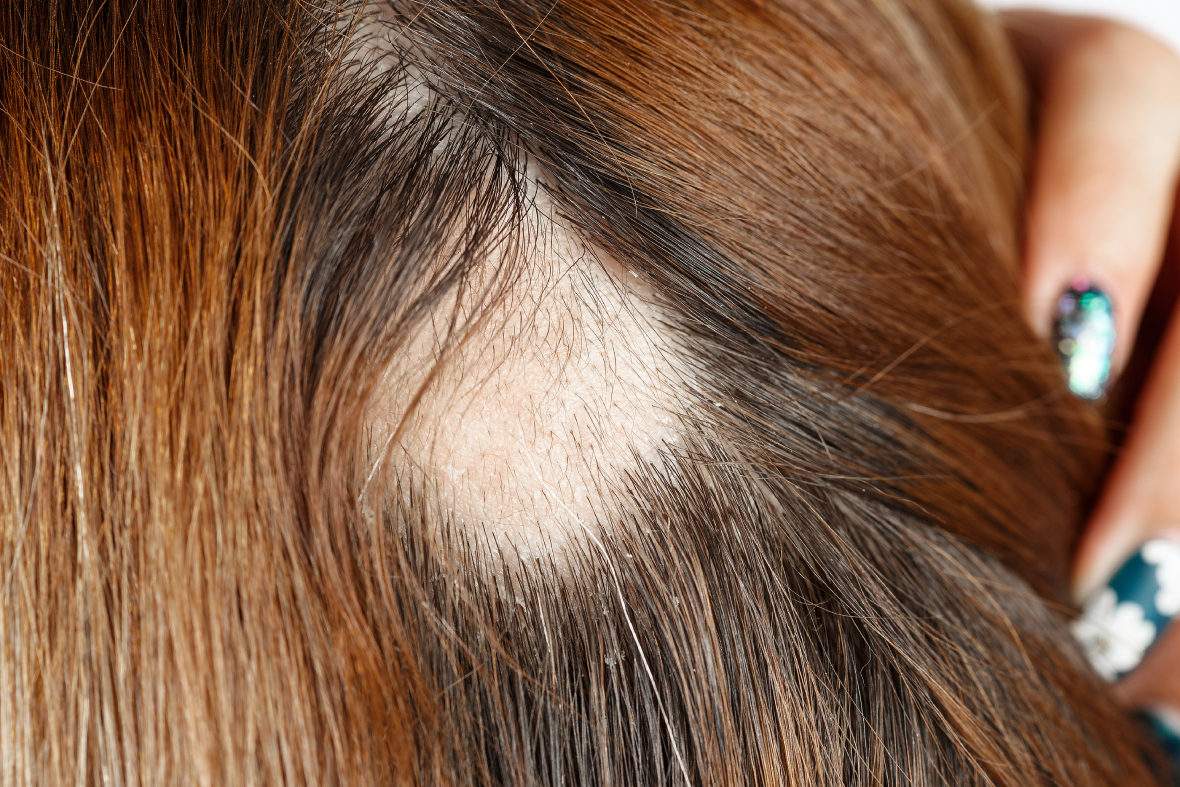 Overcoming Scarring Alopecia: Symptoms & Treatment Options - Angeline Yong  Dermatology