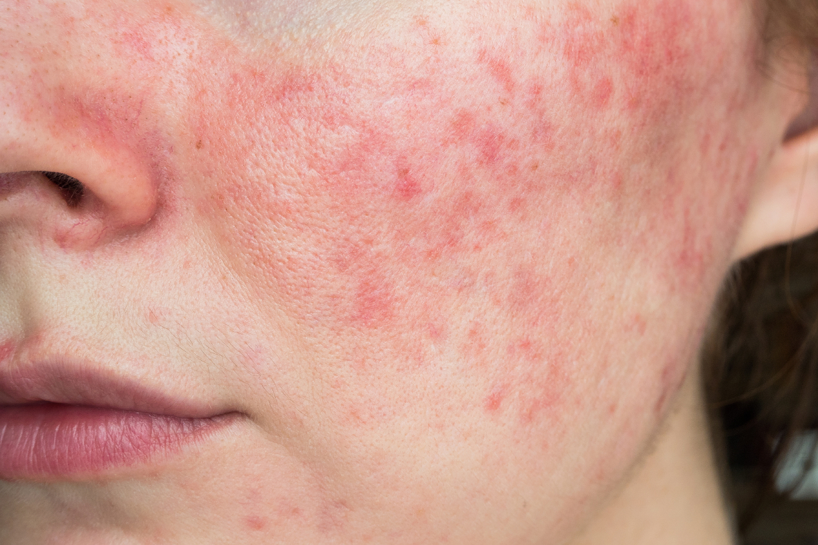 Investigating Rosacea: Treatments To Overcome The Redness