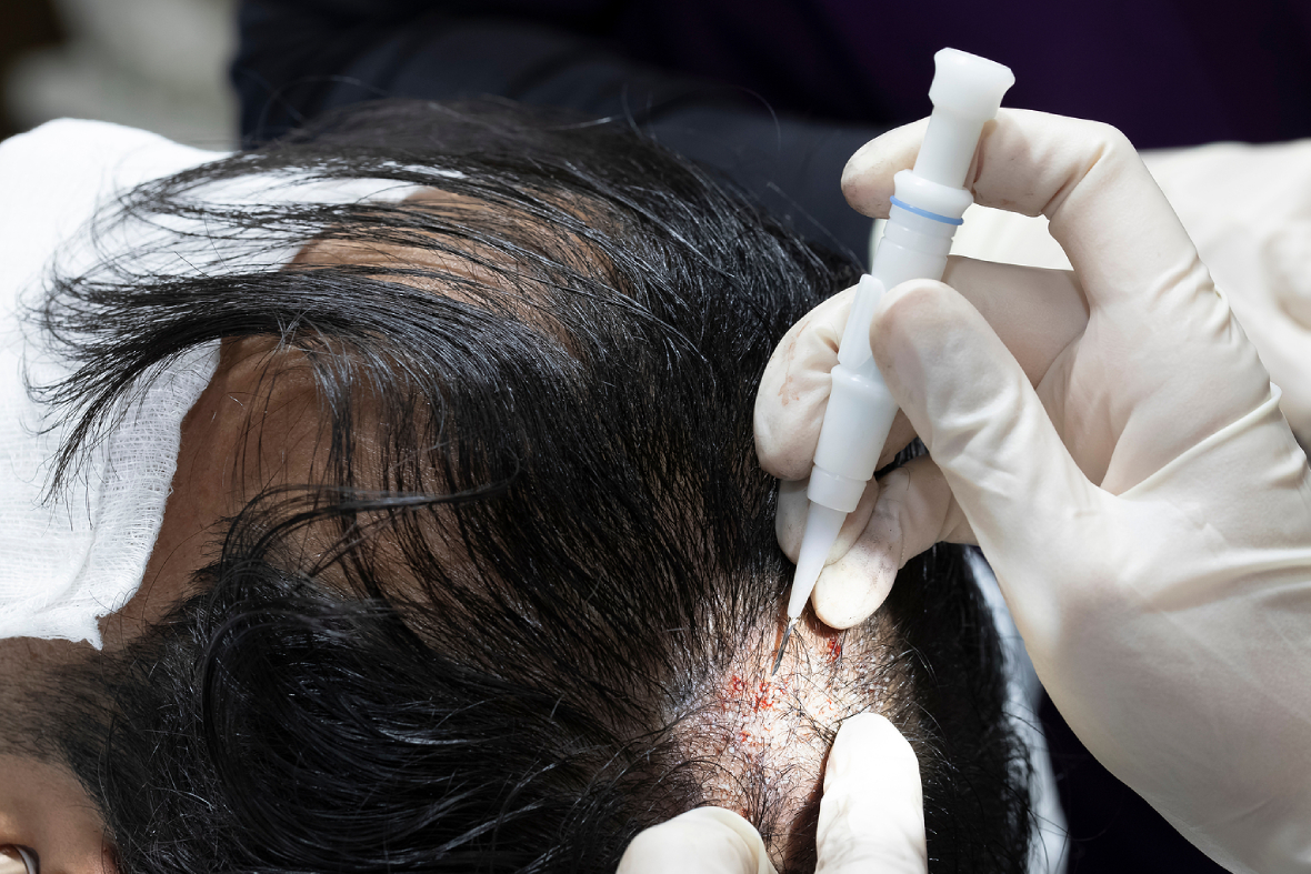 A Guide On How Your Hair Transplant Eligibility Is Decided