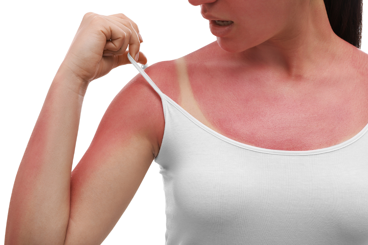 A Guide To Sunburn: Factors And Recommended Treatments