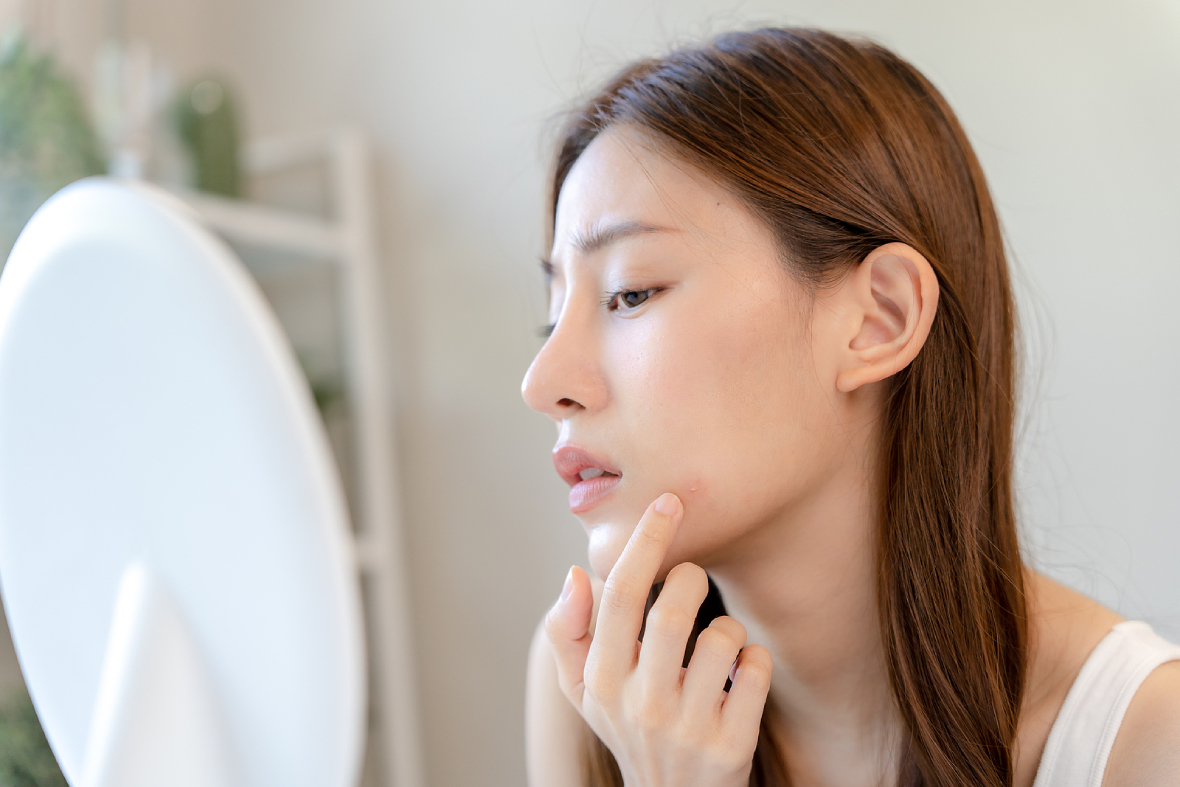 Acne Breakouts: The Message The Placement Is Giving You