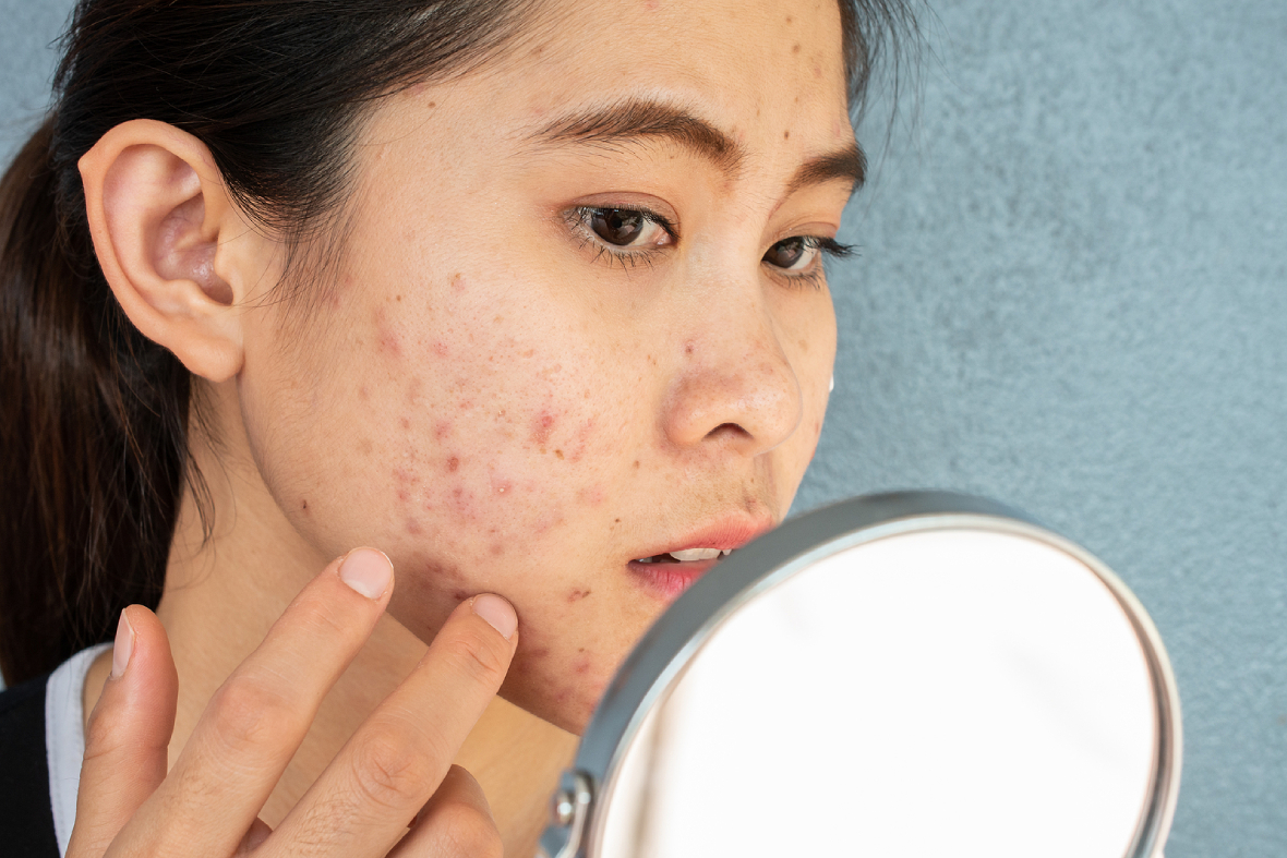 An In-depth Look Into Acne Scars: Causes And Treatment