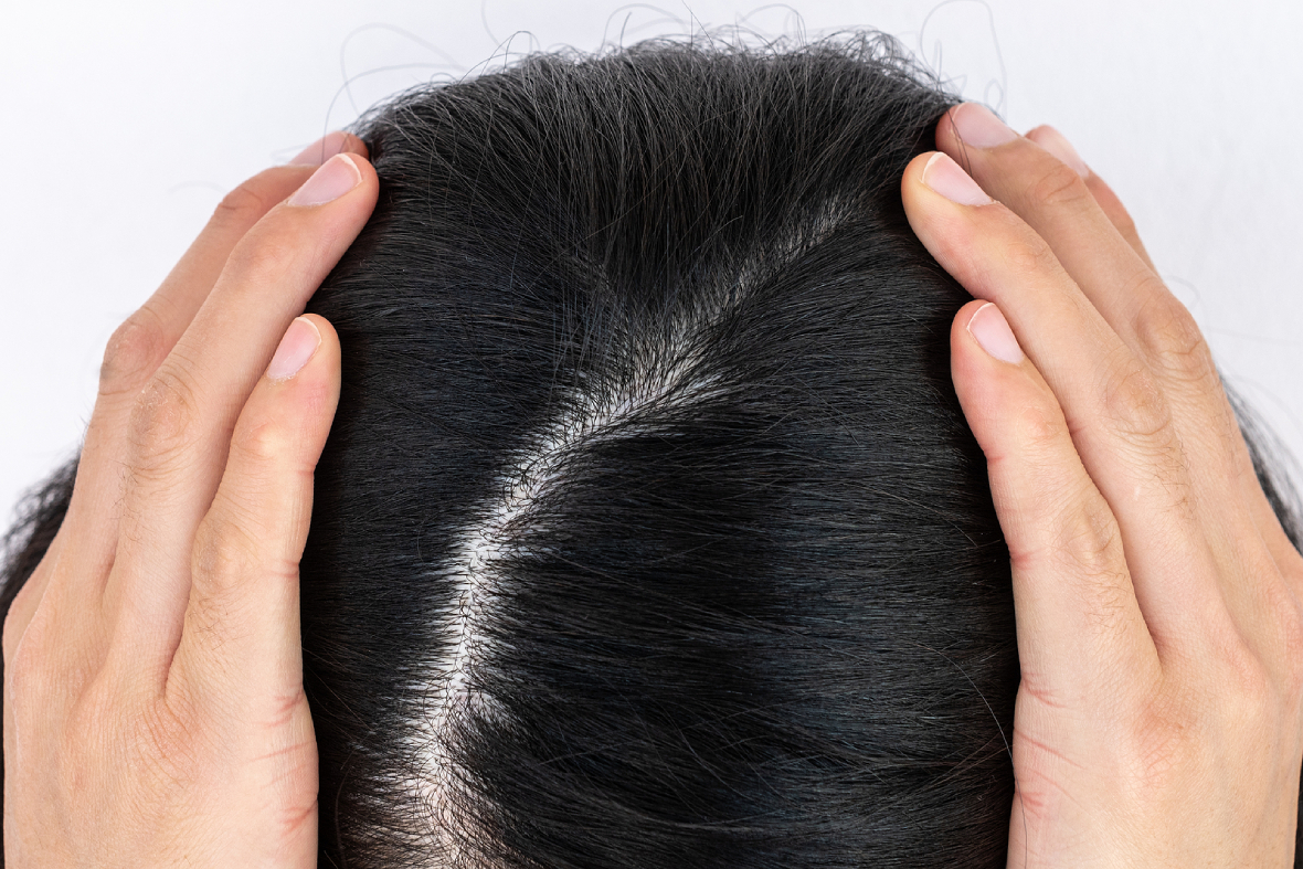 The Different Methods For Treating Female Pattern Hair Loss