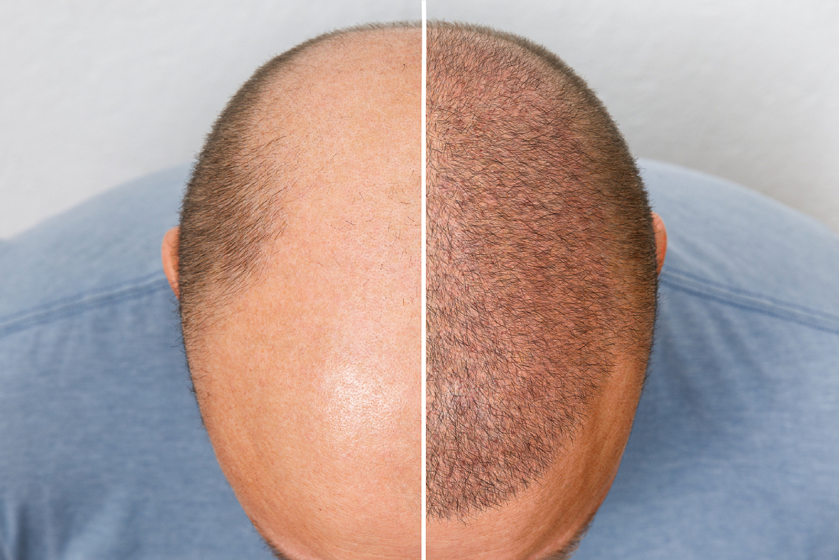 The Most Frequently Asked Questions After A Hair Transplant