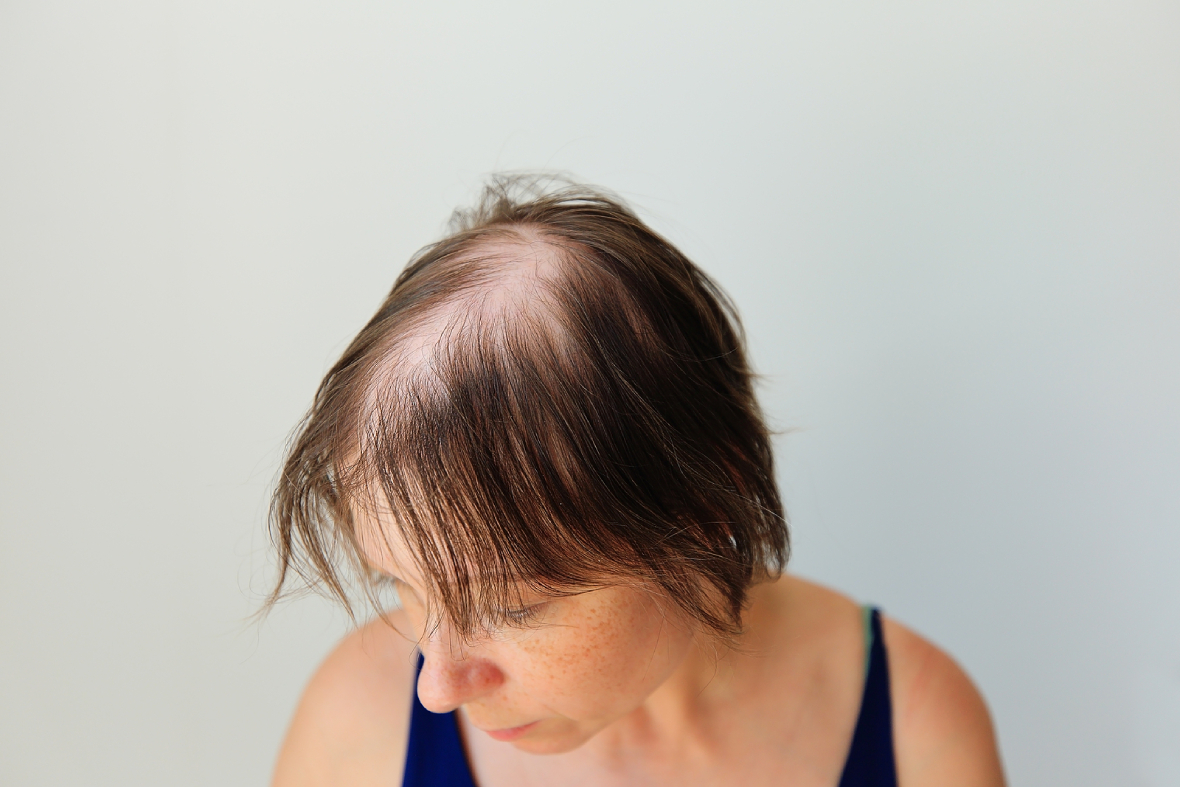 Olumiant: The New Treatment Option For Those With Hair Loss