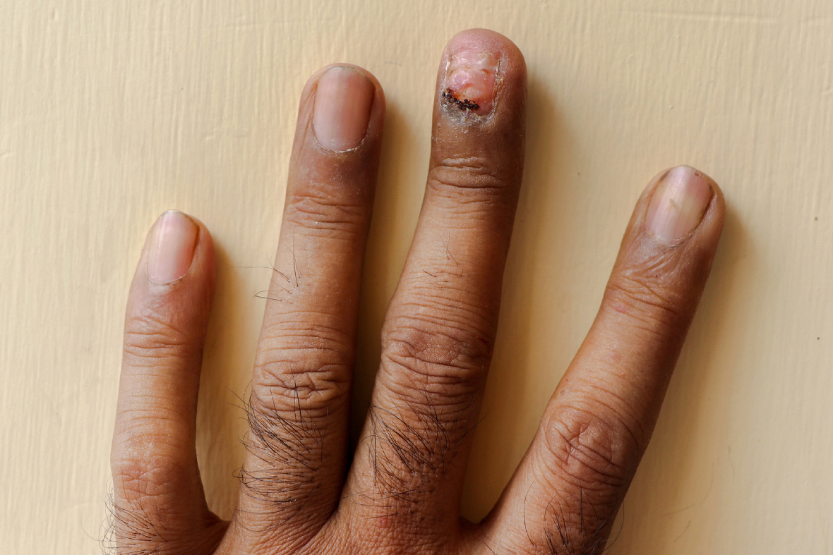 Fungal Nail Infection - Infected Finger Nail | familydoctor.org