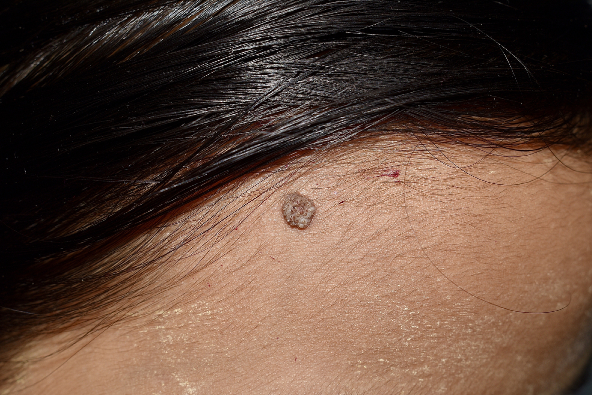 Mole Removal: A Comprehensive Guide On What To Expect
