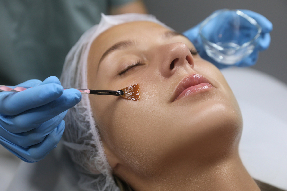Chemical Peels: An In-Depth Look Into Their Benefits