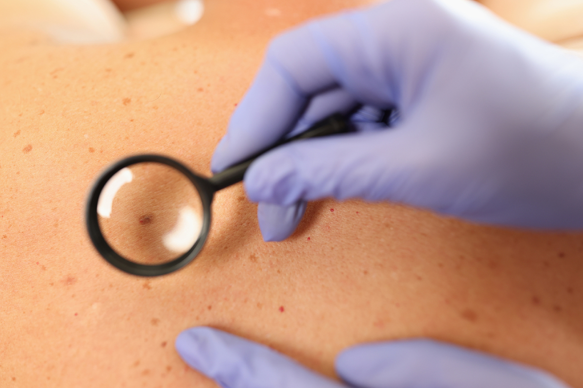The Undeniable Importance Of Getting A Skin Cancer Screening
