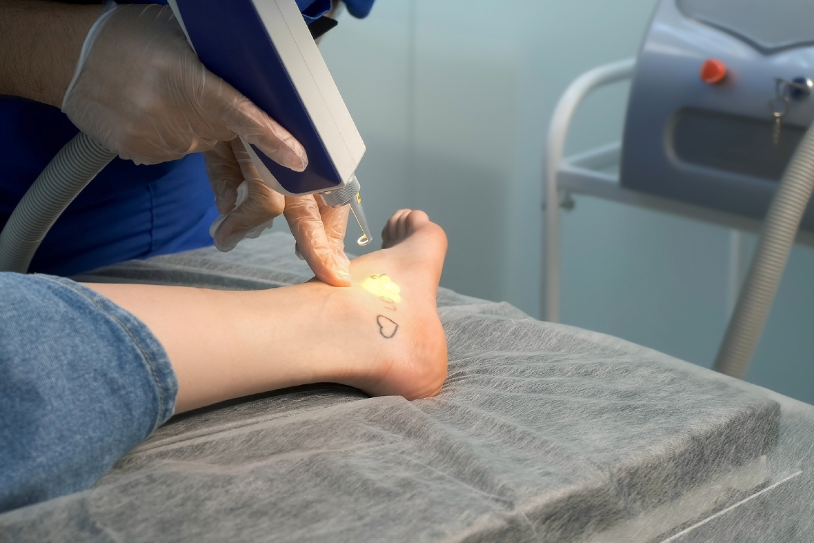 Top 6 Frequently Asked Questions About Tattoo Removal