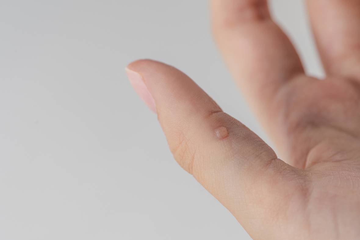 Don't Be Fooled: 3 Viral Wart Removal Myths Debunked