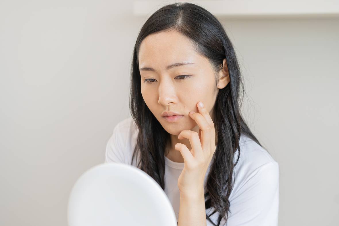 Tell-Tale Signs Your Acne Requires Professional Attention