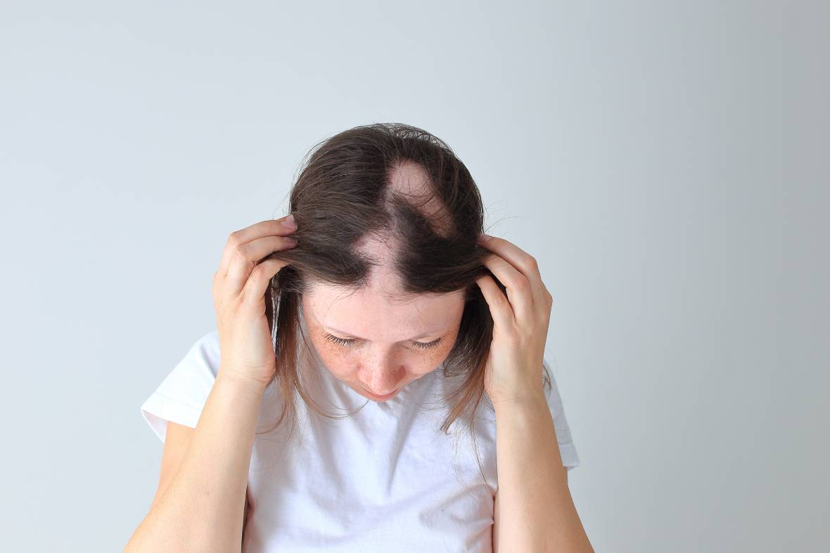 Alopecia Areata: Baricitinib & Ritlecitinib For Hair Regrowth