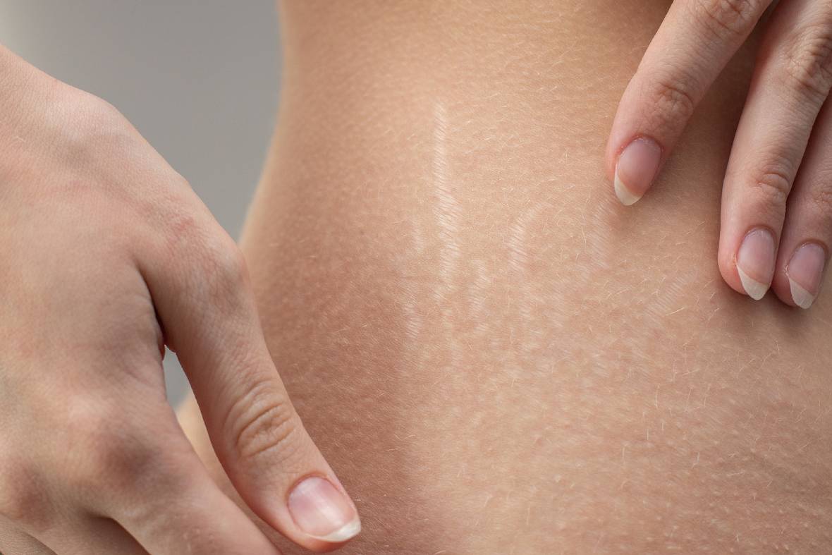Stretch Marks: An In-Depth Look Into How They Develop