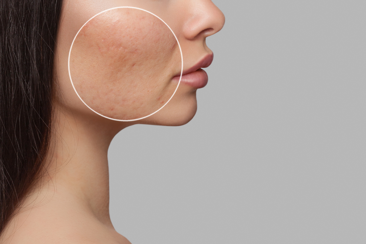 Understanding The Different Types Of Acne & How To Treat Them