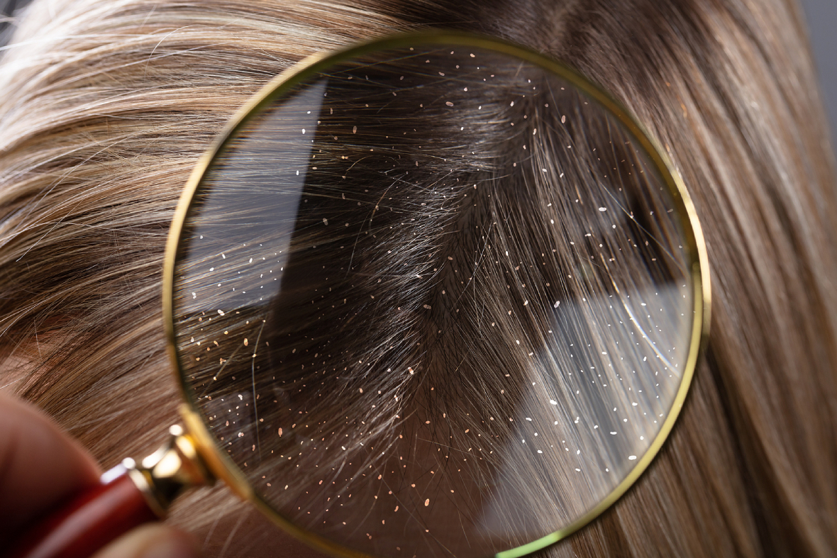The Hidden Connection: How Are Hormones And Dandruff Related?