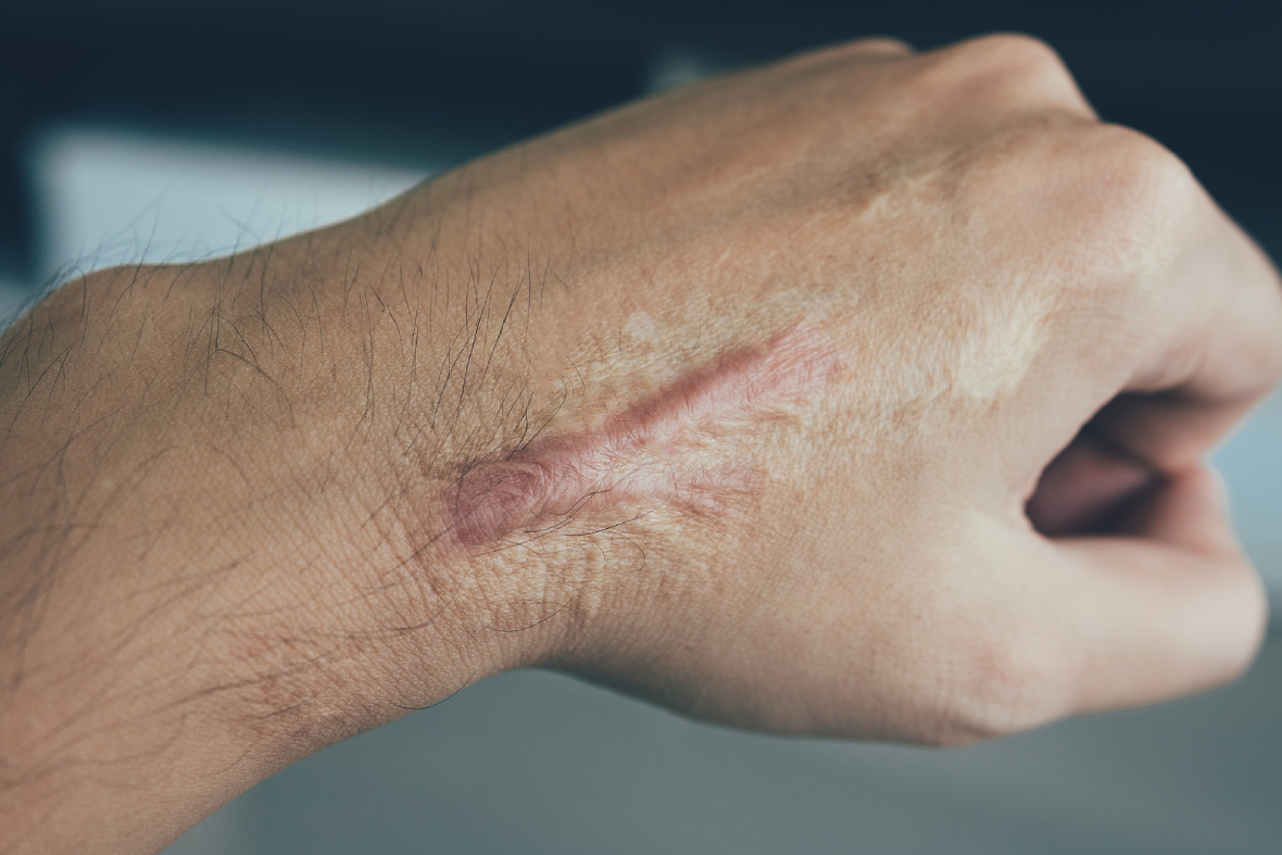 Managing Hypertrophic & Keloid Scars: Tips & Treatment Options