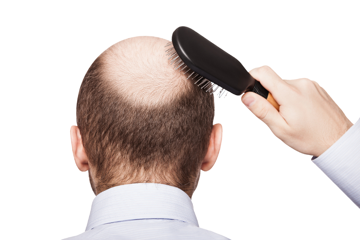 The Link Between DHT And Hair Loss: What You Need To Know