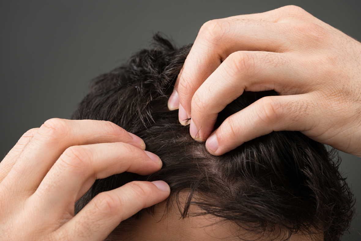 Minoxidil Vs Finasteride: Which Hair Loss Treatment Works Best?