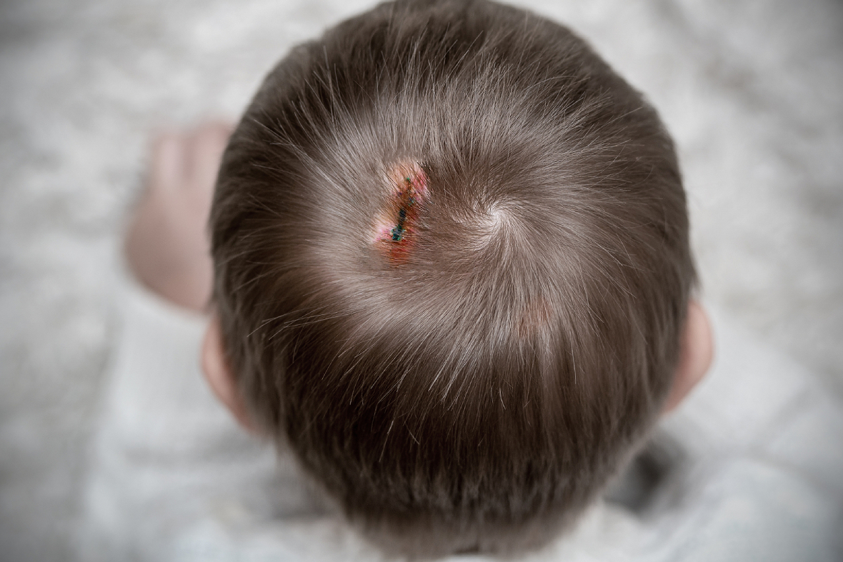 Hair Transplant On Scars: When to Do It & What to Expect