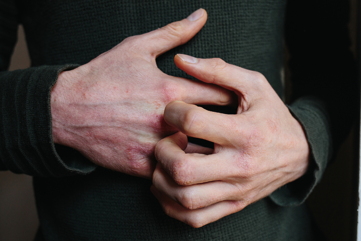 Why Won’t My Eczema Go Away? A Dermatologist Shares Why