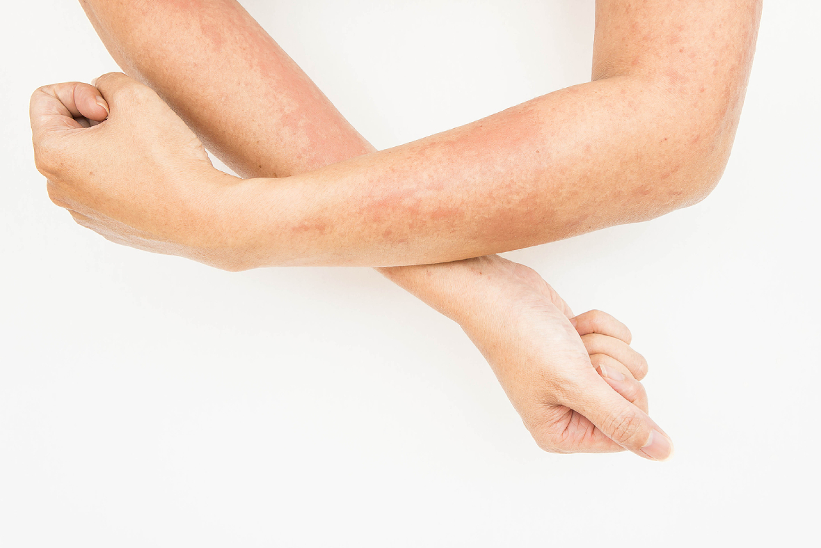 Atopic Or Contact Dermatitis? Learn How To Spot & Treat Each