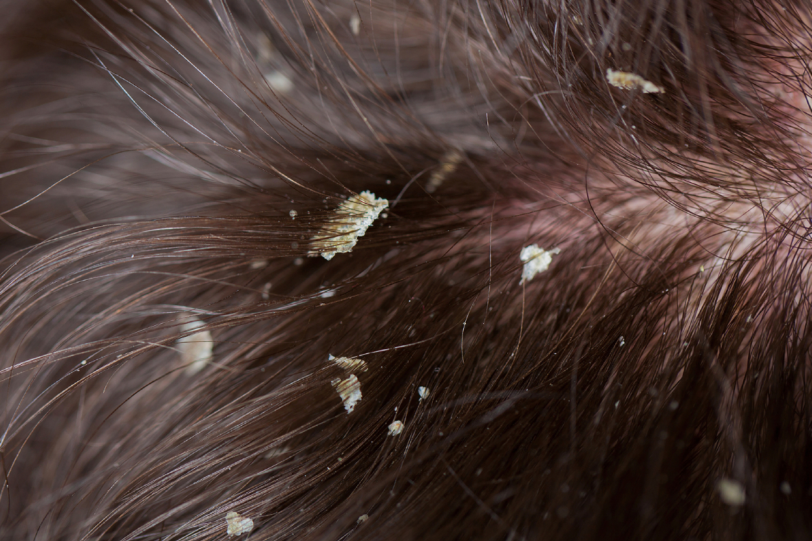 Dry Scalp Vs Dandruff: Signs, Causes, And Solutions