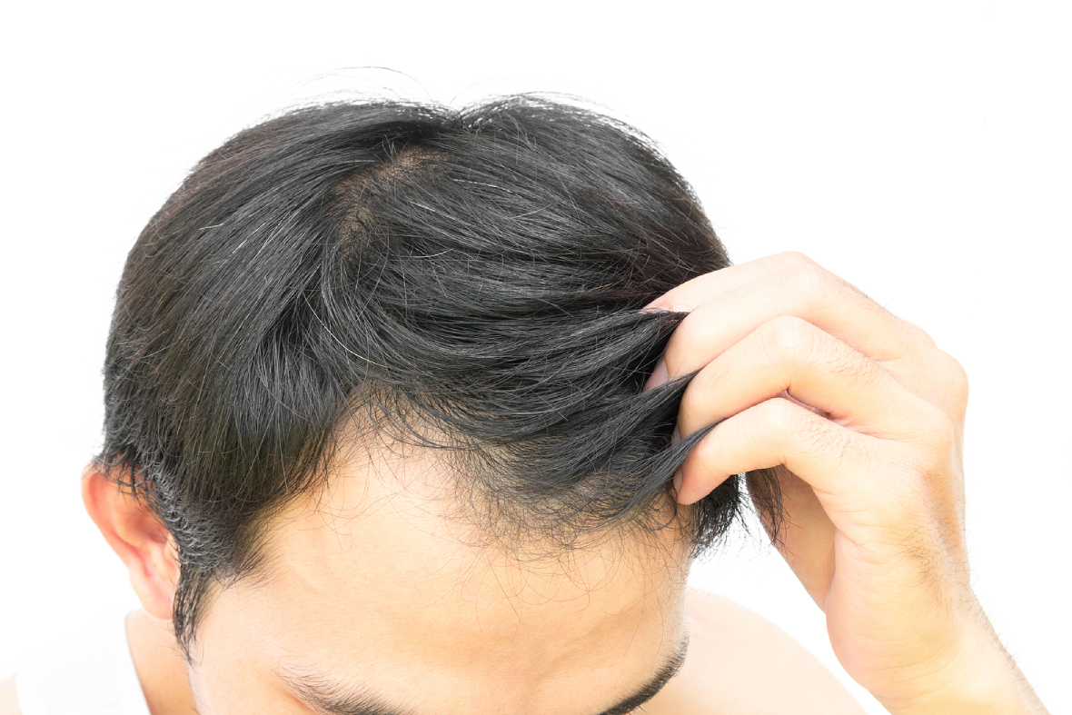 Are ‘Cheap’ Hair Transplants Abroad Worth The Risk?