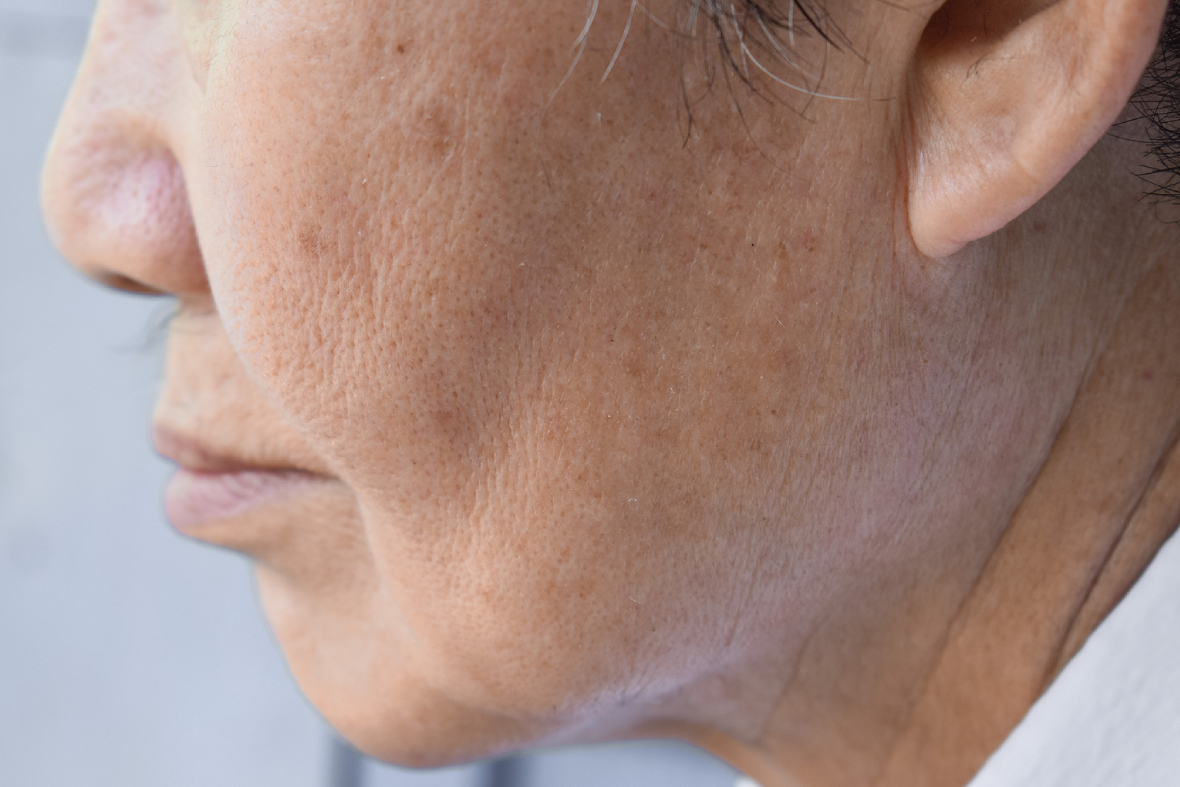 The Pore Size Myth: What Actually Works And What Doesn’t