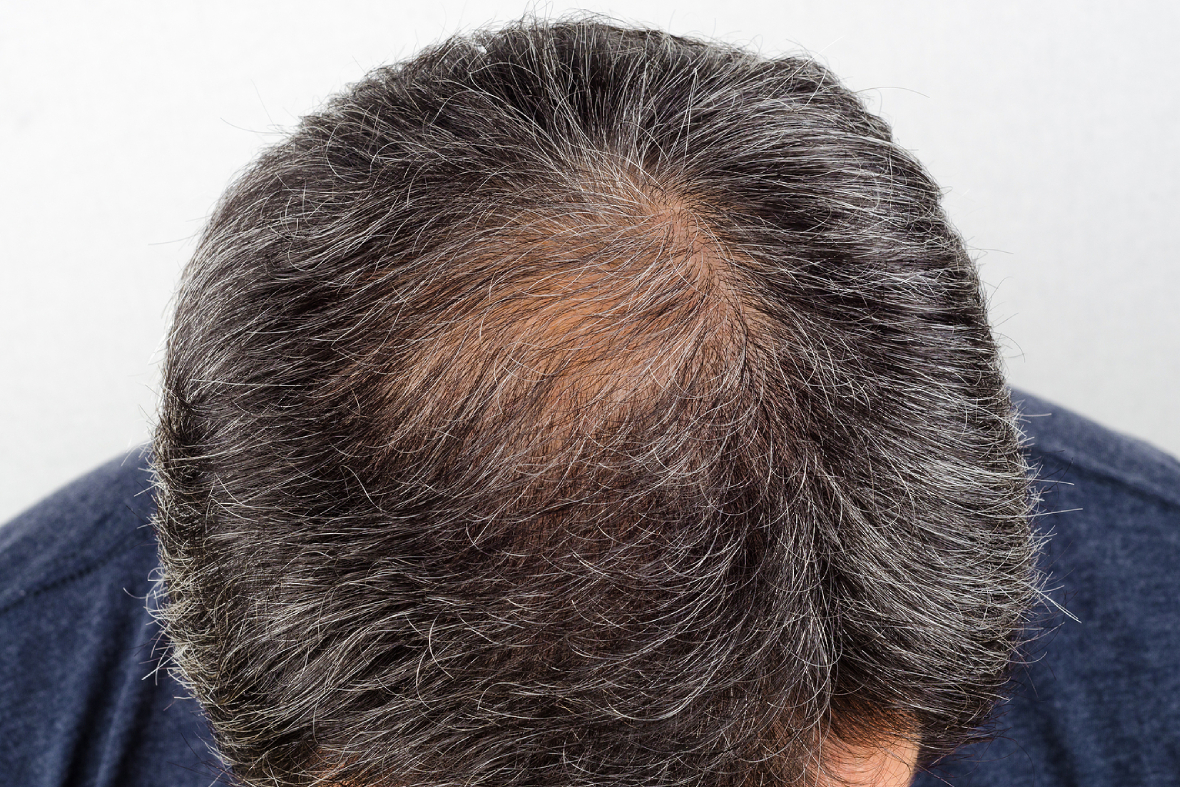 Is Stem Cell Therapy The Future Of Hair Restoration?