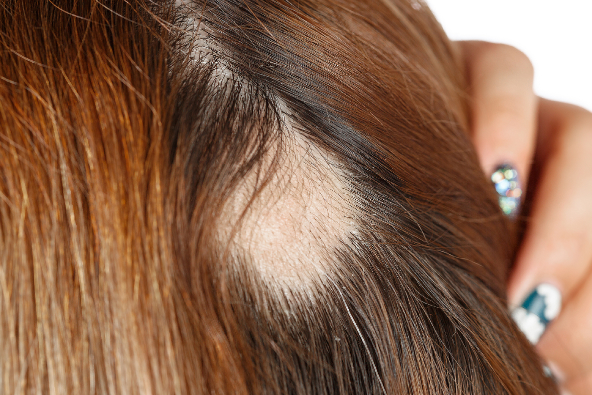 Alopecia Areata: Why The Immune System Attacks Hair Follicles