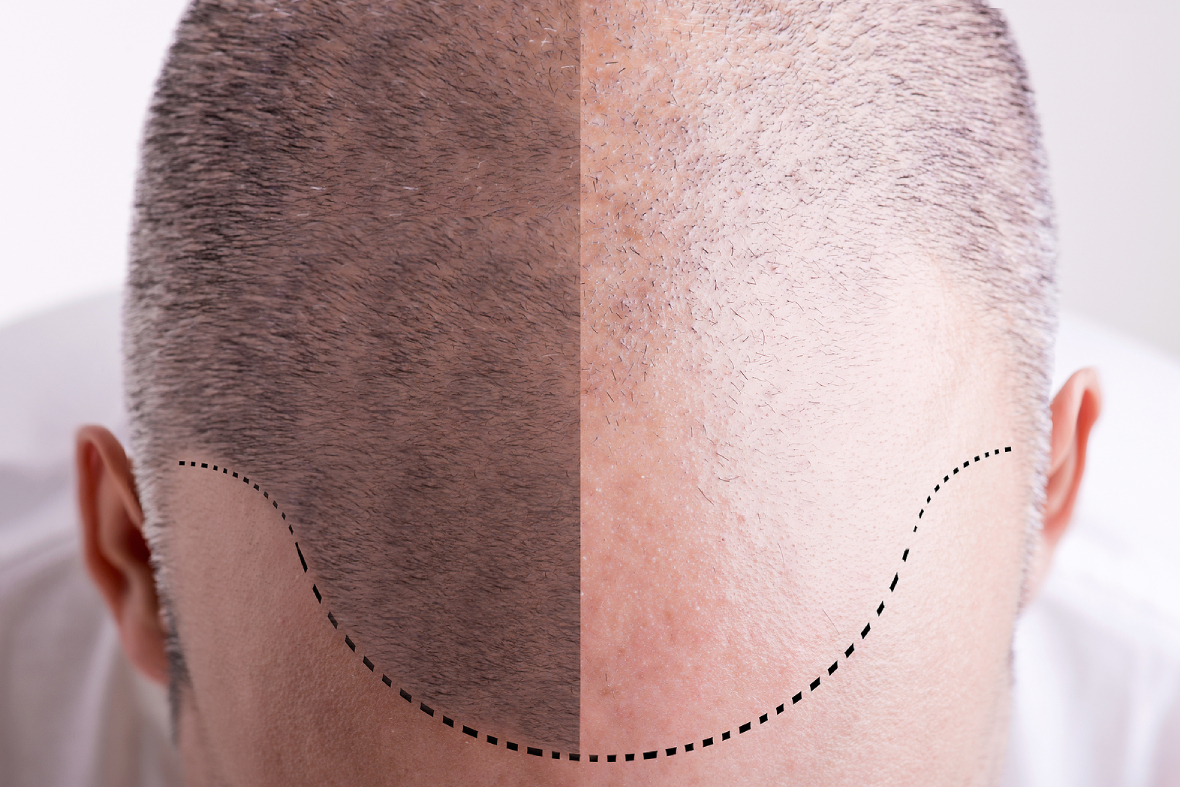 Hair Transplant Failures: Why They Happen & How To Avoid Them