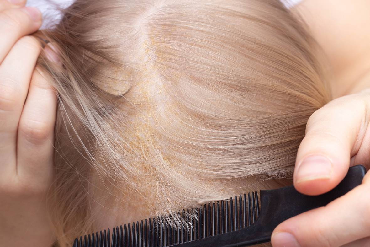 Why Singapore's Humidity Makes Seborrhoeic Dermatitis Worse