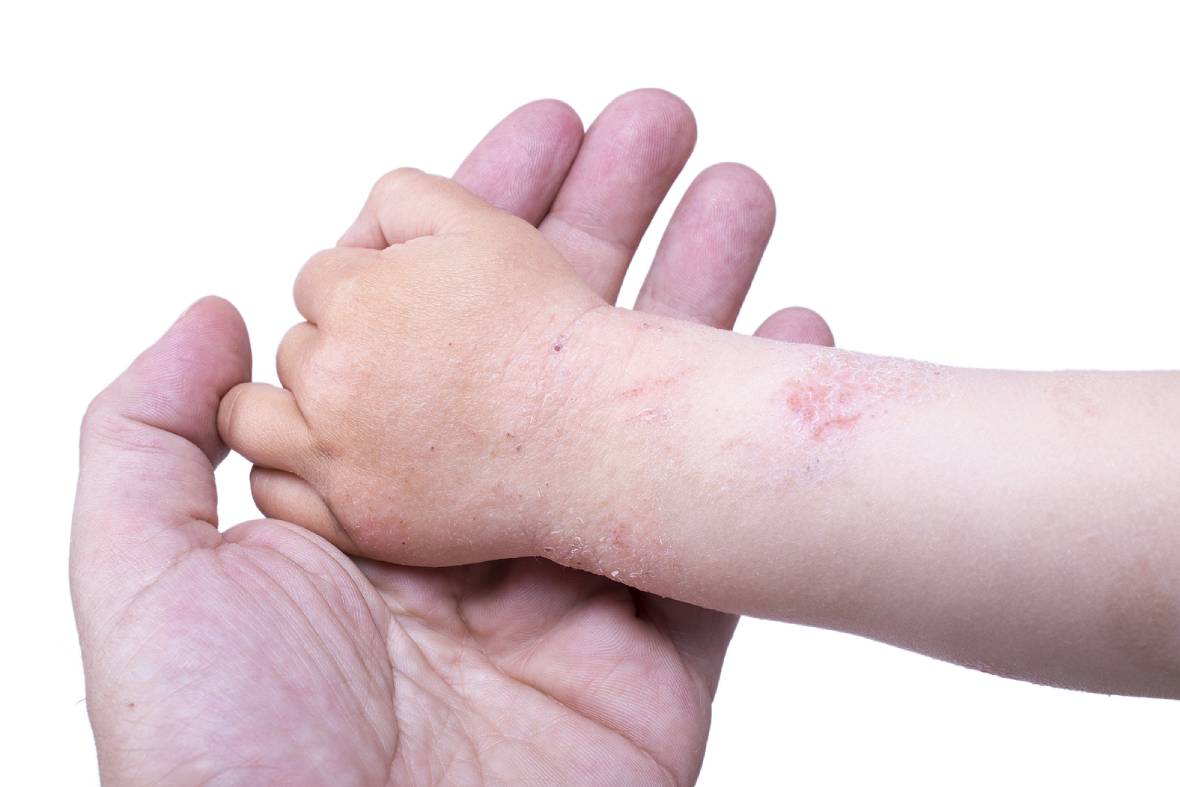 Your Child Has Eczema: A Parent's Guide To Managing It Safely