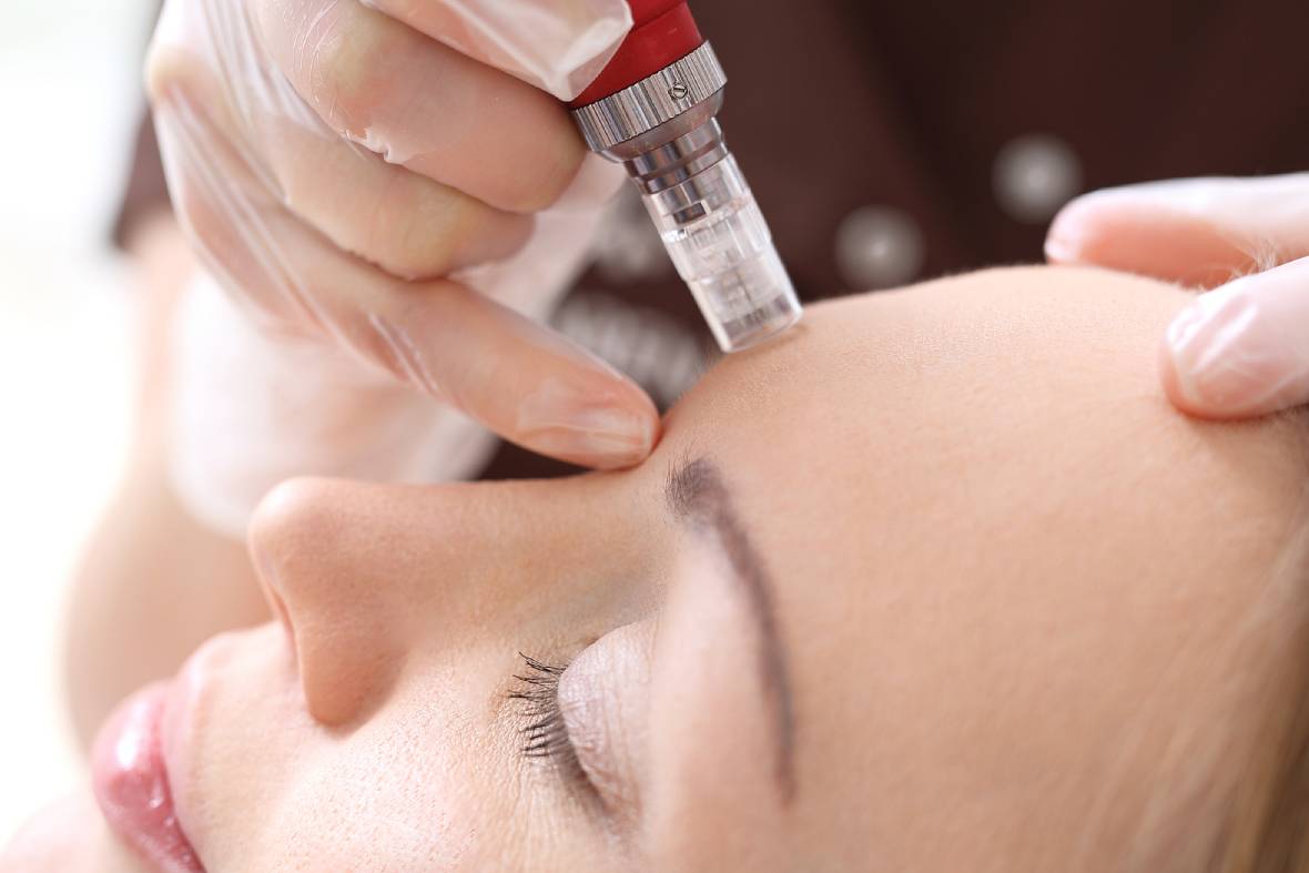 Acne Scar Treatment: Comparing Laser, Subcision, Microneedling