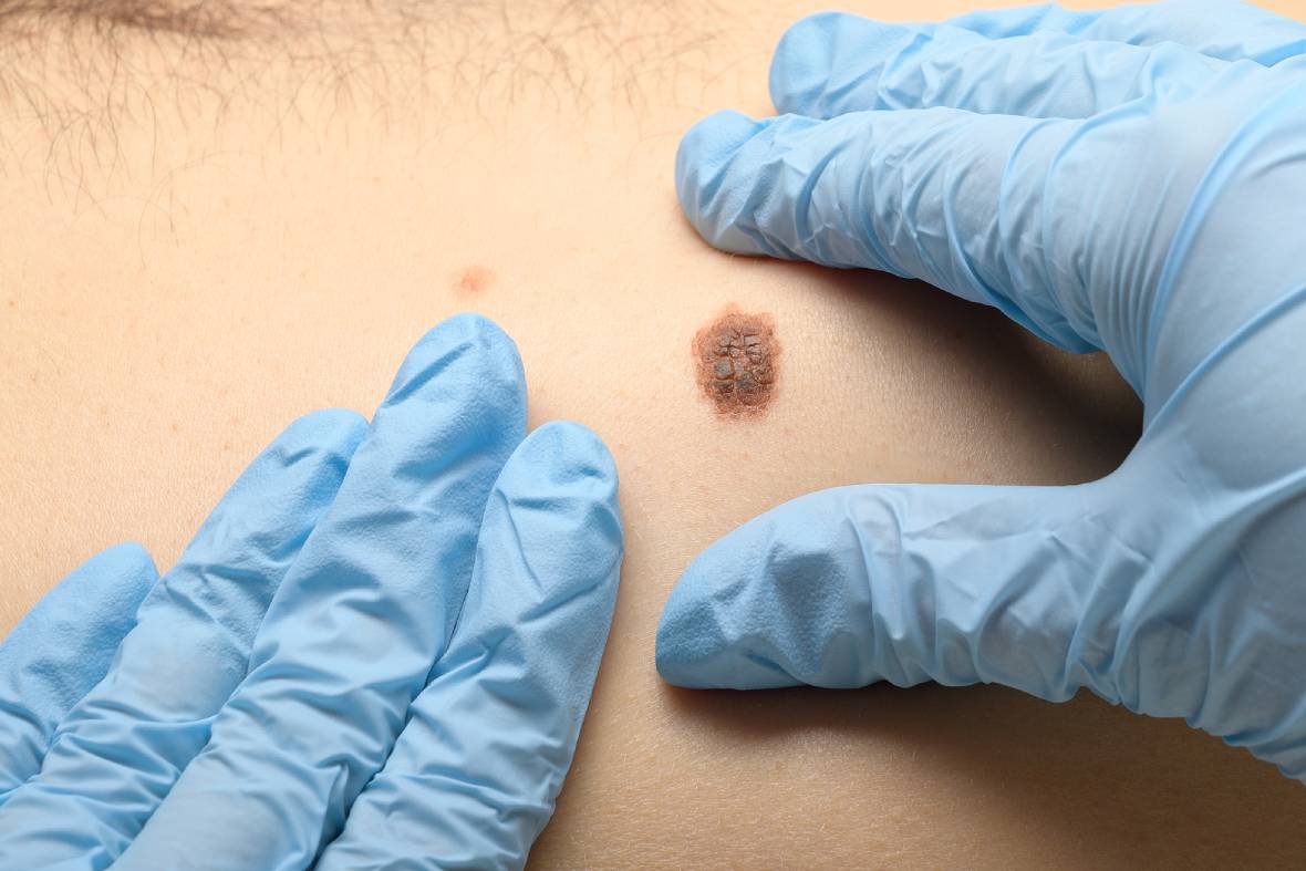 Skin Cancer Treatment Options: Topical Therapy, Mohs Surgery
